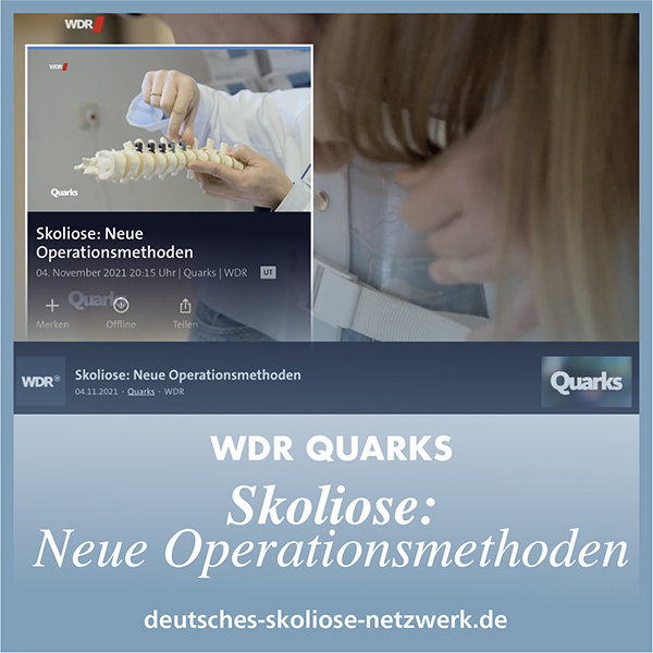 Skoliose: Neue Operationsmethoden