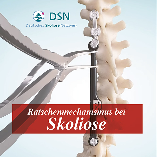 Der Ratschenmechanismus bei Skoliose